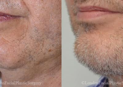 Chin Implants in London Before & After Results