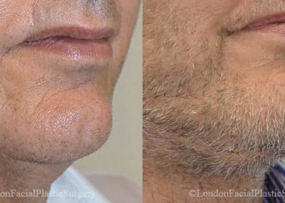 Chin Implants in London Before & After Results