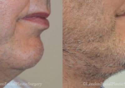 Chin Implants in London Before & After Results