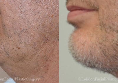 Chin Implants in London Before & After Results