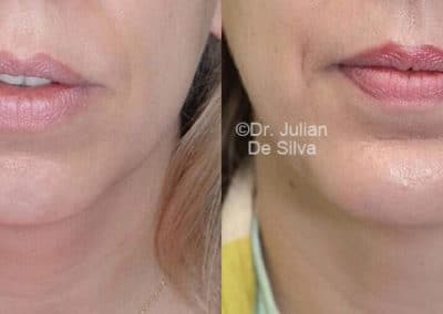 Chin Implants in London Before & After Results