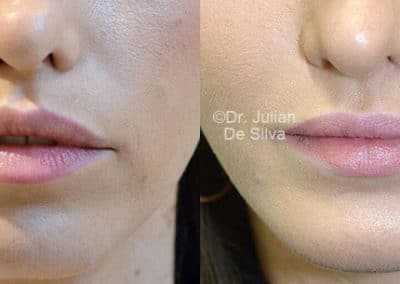 Chin Implants in London Before & After Results