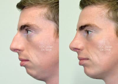 Chin Implants in London Before & After Results