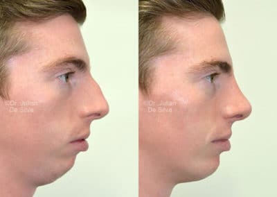 Chin Implants in London Before & After Results