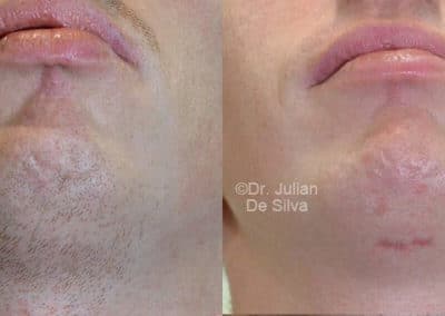 Chin Implants in London Before & After Results