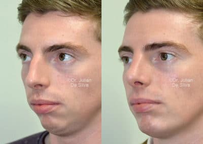 Chin Implants in London Before & After Results