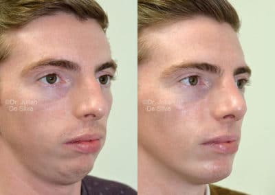 Chin Implants in London Before & After Results