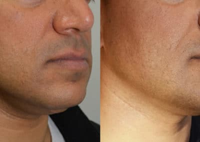 Chin Implants in London Before & After Results