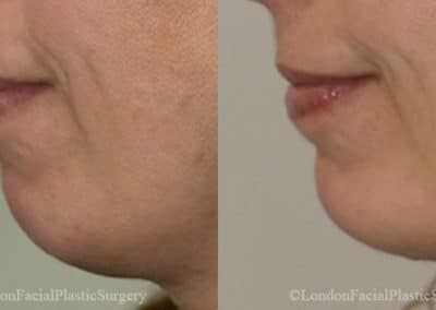 Chin Implants in London Before & After Results