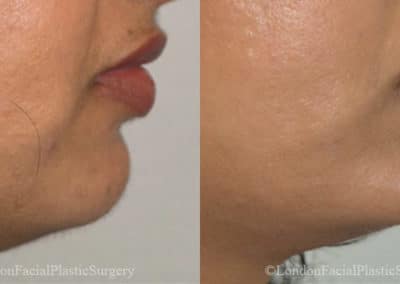 Chin Implants in London Before & After Results