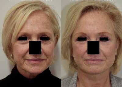 Facelift in London Before & After Results