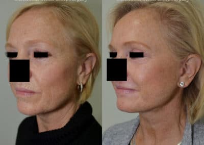 Facelift in London Before & After Results