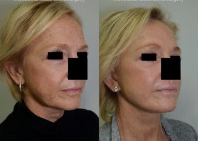 Facelift in London Before & After Results