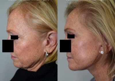 Facelift in London Before & After Results