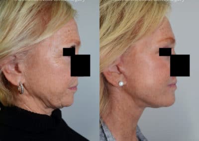 Facelift in London Before & After Results