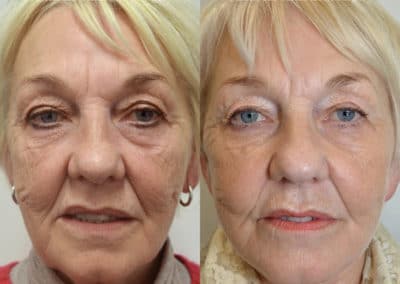 Facelift in London Before & After Results