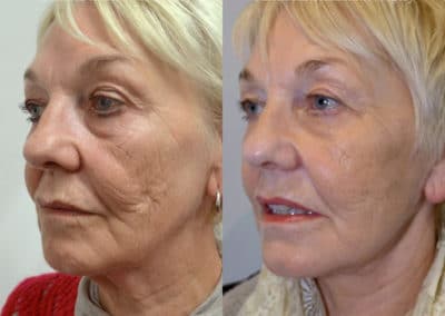 Facelift in London Before & After Results