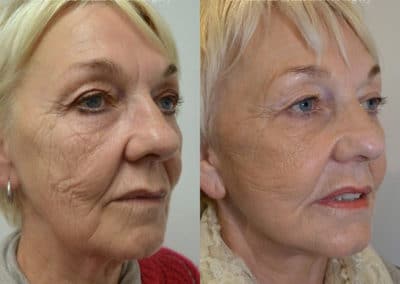 Facelift in London Before & After Results