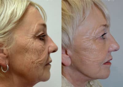 Facelift in London Before & After Results