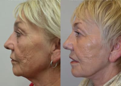 Facelift in London Before & After Results