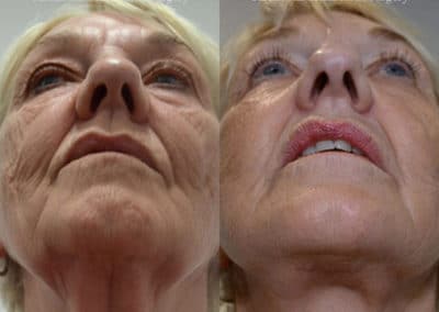 Facelift in London Before & After Results