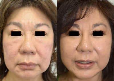 Facelift in London Before & After Results