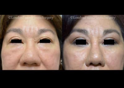 Facelift in London Before & After Results