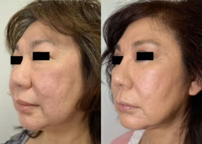 Facelift in London Before & After Results