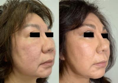 Facelift in London Before & After Results