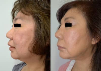 Facelift in London Before & After Results