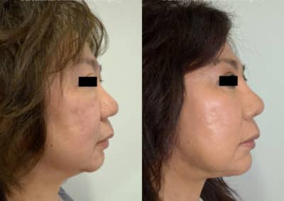 Facelift in London Before & After Results