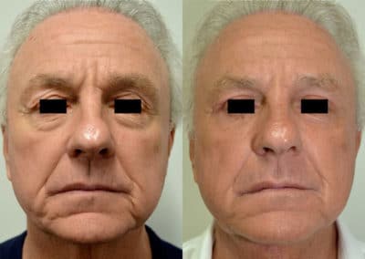 Facelift in London Before & After Results