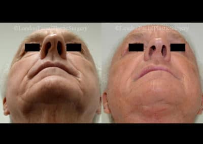 Facelift in London Before & After Results