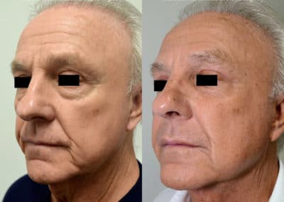 Facelift in London Before & After Results