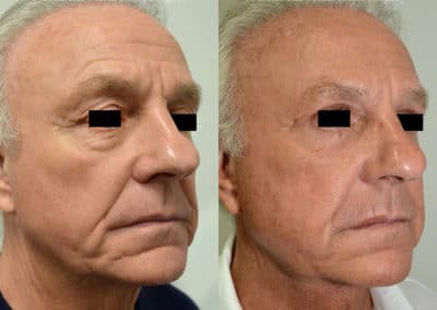 Facelift in London Before & After Results