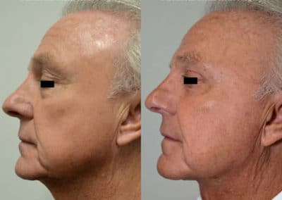 Facelift in London Before & After Results