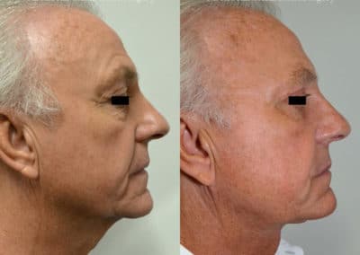 Facelift in London Before & After Results