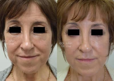 Facelift in London Before & After Results