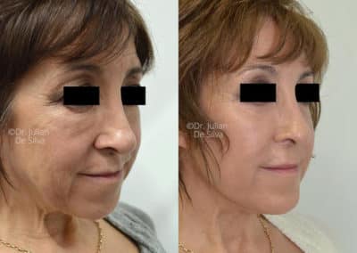 Facelift in London Before & After Results