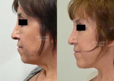 Facelift in London Before & After Results