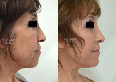 Facelift in London Before & After Results