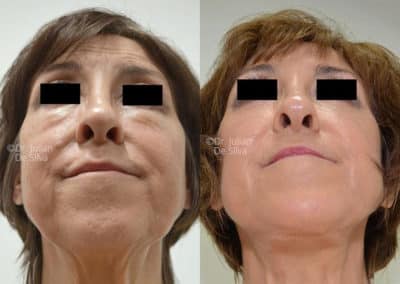 Facelift in London Before & After Results