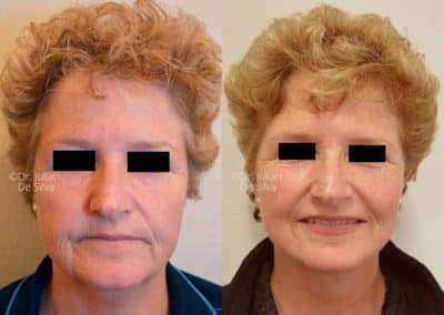 Facelift in London Before & After Results