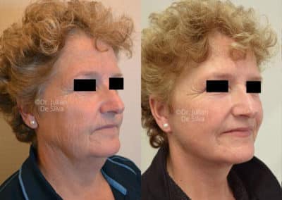 Facelift in London Before & After Results