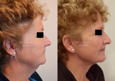 Facelift in London Before & After Results