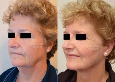 Facelift in London Before & After Results