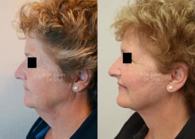 Facelift in London Before & After Results