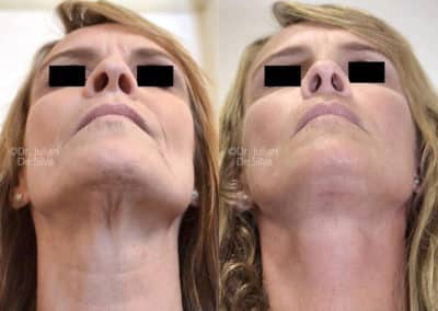 Facelift in London Before & After Results