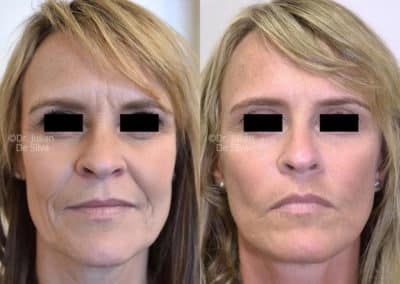 Facelift in London Before & After Results