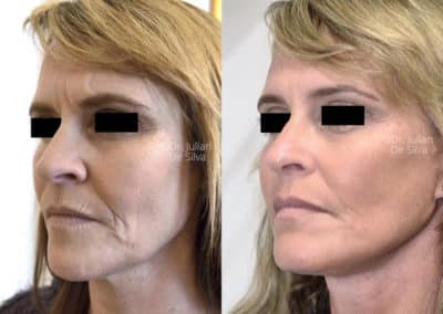 Facelift in London Before & After Results